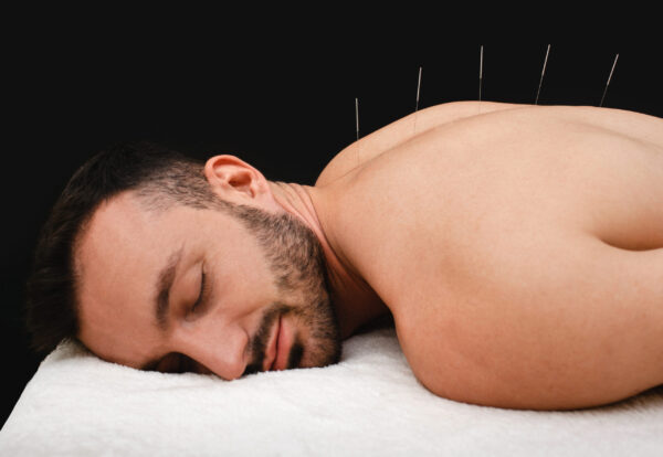 Acupuntura